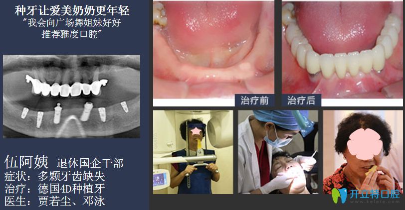 廣州種植牙價(jià)格表,看廣州穗華/柏德/德倫等排名前10醫(yī)院收費(fèi)