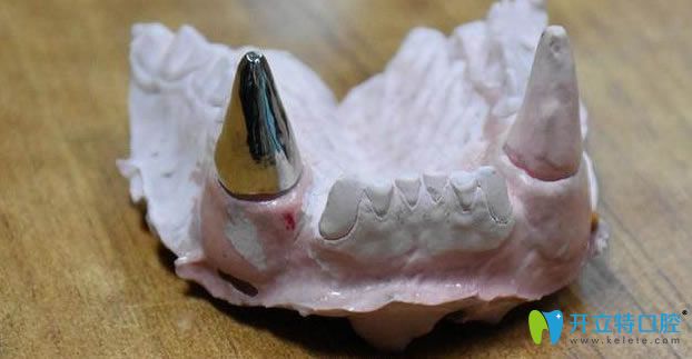 為什么要給“團(tuán)團(tuán)”選擇“鈦金屬”材牙套