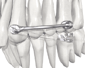 牙齒矯正中牙齒移動圖