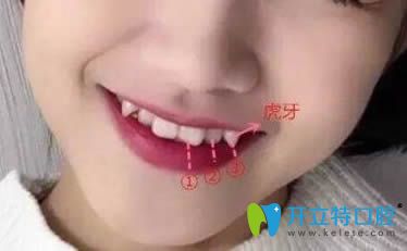 談虎牙矯正好還是拔除好?矯正虎牙(尖牙)價格是多少錢？