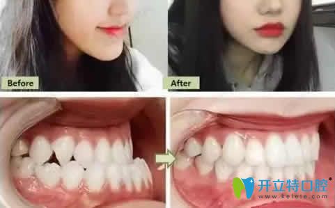 成人牙齒矯正為什么需要2年左右時間?正畸只要一年靠譜嗎?