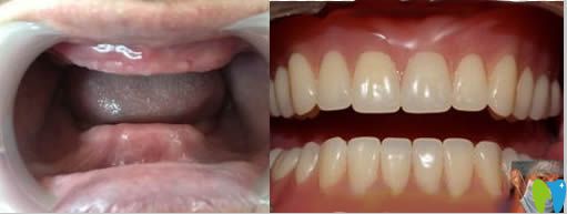 隱形義齒真人佩戴效果對比圖