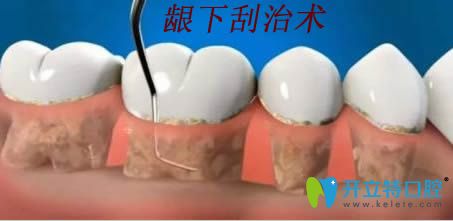 齦下刮治術(shù)操作過(guò)程示意圖