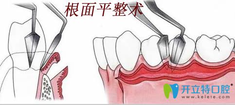 牙周治療之根面平整術(shù)操作過(guò)程圖