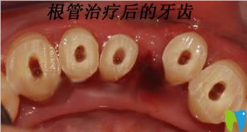 做過(guò)根管治療后的牙齒圖
