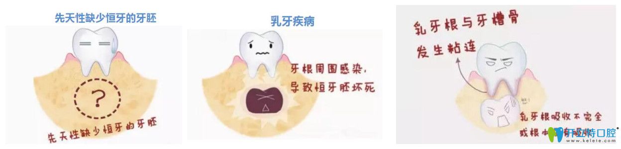 孩子為什么會出現(xiàn)乳牙滯留的原因