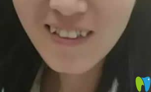 牙齒矯正改變臉型嗎？附我在西安優(yōu)德口腔正畸15個月效果圖