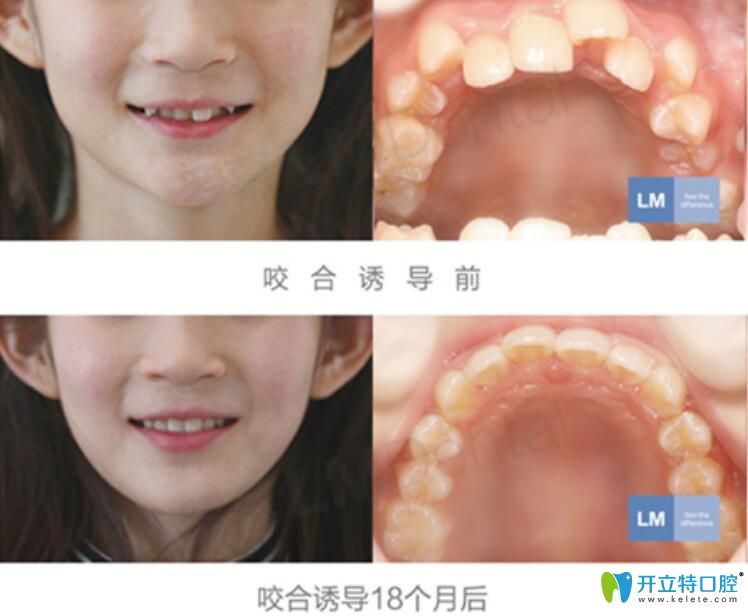 <!--<i data=20240703-sp></i>-->兒童口腔好不好？來(lái)看兒童羅慕誘導(dǎo)矯正案例