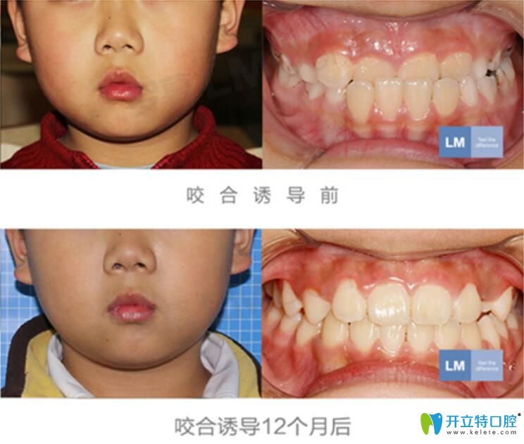 男孩在<!--<i data=20240703-sp></i>-->兒童口腔做落幕咬合誘導(dǎo)矯正案例對(duì)比圖