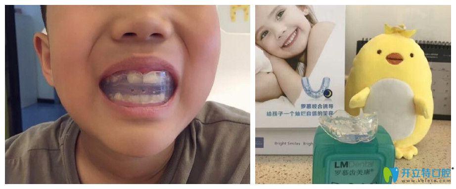 重慶牙齒矯正哪里好？茁悅口腔牙齒正畸案例效果來說明