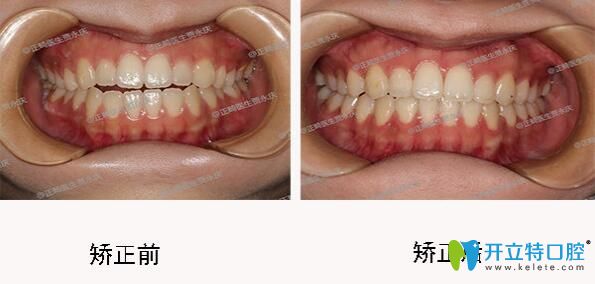 成都口腔哪里正畸好？圣貝口腔牙齒矯正效果來揭曉