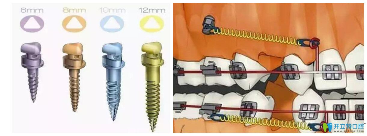 牙齒矯正打骨釘疼嗎？牙齒矯正是不是必須打骨釘？