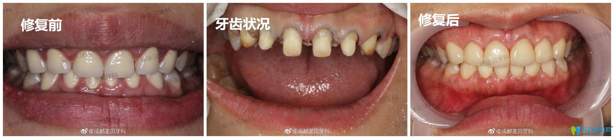 圣貝口腔牙齒修復(fù)案例