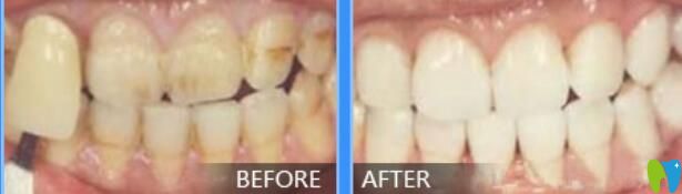 20190114927594.jpg北京中諾口腔陳劍明案例