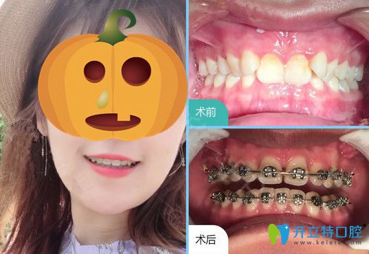 韋博口腔牙齒矯正前后變化圖