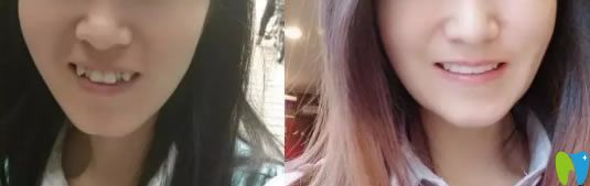 湛江致美口腔隱形牙齒矯正前后對比圖