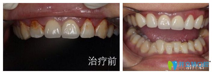 <!--<i data=20240703-sp></i>-->口腔趙中華怎么樣？來看真人案例效果