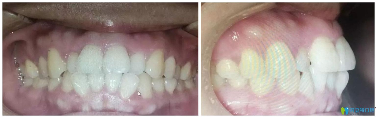 找趙中華做牙齒矯正前口腔正面、側(cè)面照