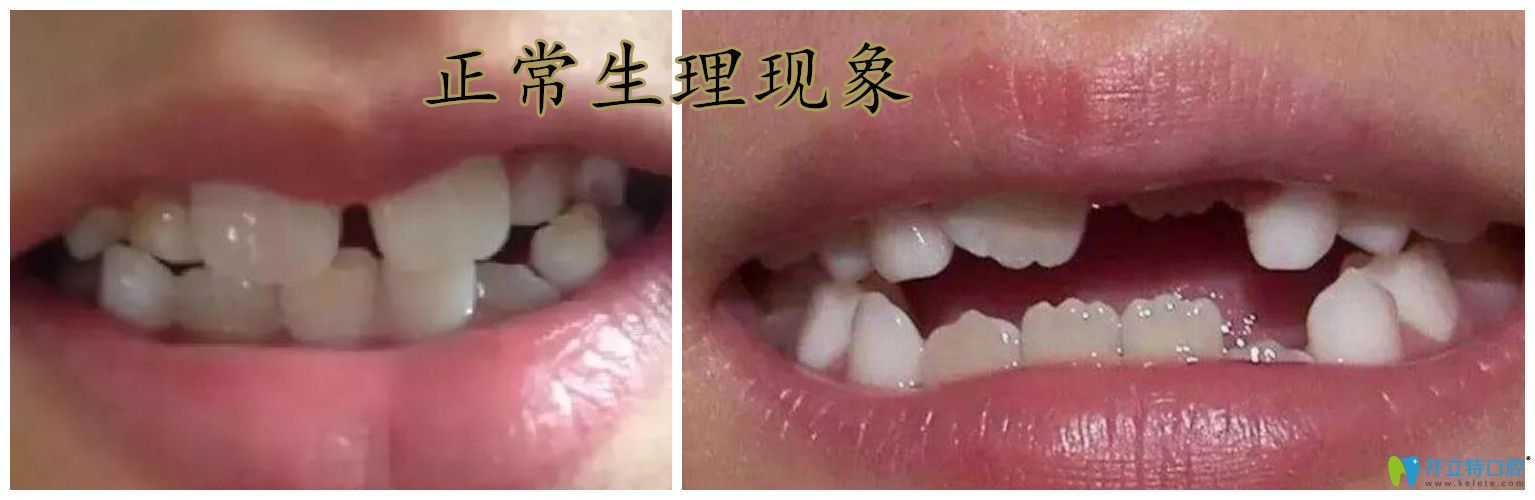 小孩新牙是鋸齒牙正常嗎