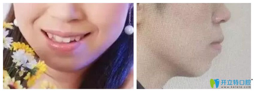 去<!--<i data=20240703-sp></i>-->口腔做牙齒矯正前正面、側(cè)面照