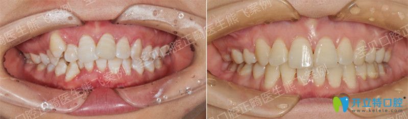 廣州圣貝口腔熊飛牙齒矯正案例