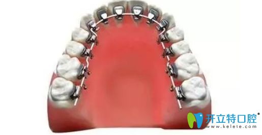 長(zhǎng)春欣雅口腔閻華醫(yī)生科普舌側(cè)矯正適合哪種牙齒等疑問(wèn)
