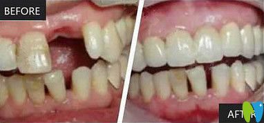 諾貝爾口腔種植牙前后對比照