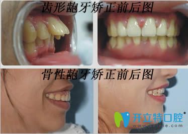 齙牙矯正矯正前后效果對比圖