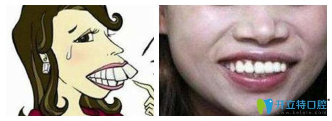 嚴(yán)重的大齙（暴）牙