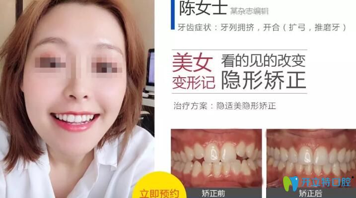 無(wú)錫北極星口腔隱適美隱形矯正案例