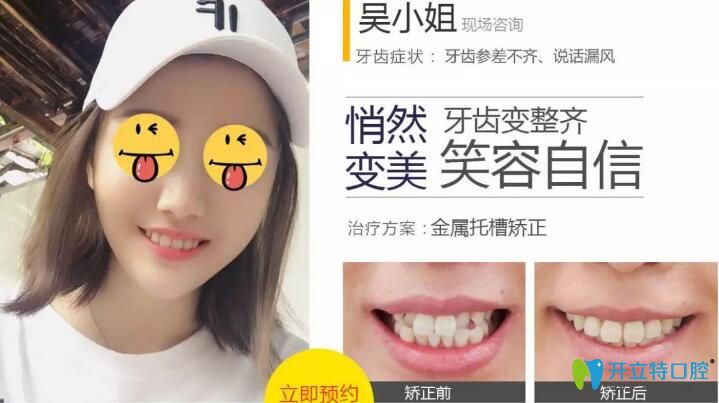 無(wú)錫北極星口腔金屬托槽矯正案例效果對(duì)比圖