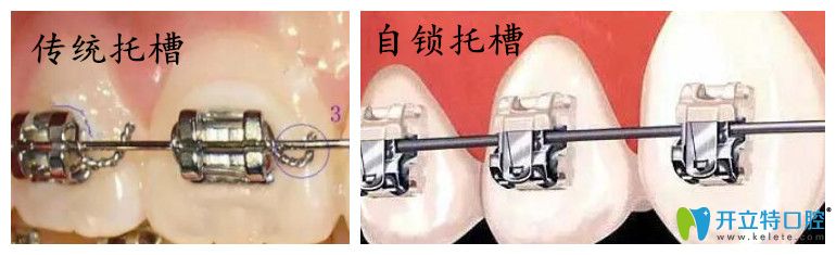 什么是自鎖托槽矯正技術