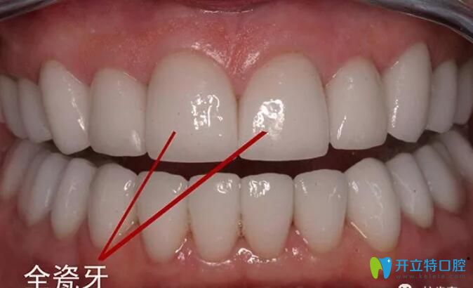 全瓷牙產(chǎn)地影響價(jià)格的，來看深圳進(jìn)口/國產(chǎn)全瓷牙多少錢一顆