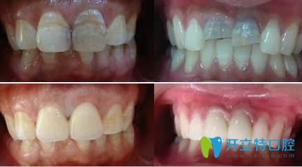 鄭州莫三心牙體修復(fù)案例效果對比圖
