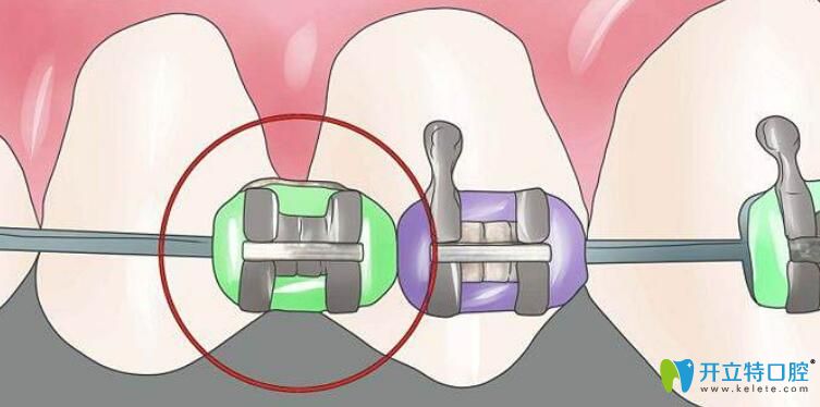 什么是自鎖托槽矯正技術(shù),價(jià)格是多少?戴自鎖矯正器過程圖解