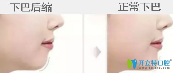 下巴后縮帶牙套有用嗎？真相揭秘下巴后縮矯正后堪比整容