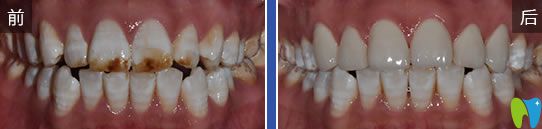 圣貝口腔氟斑牙美學(xué)貼面前后對比圖 圣貝口腔氟斑牙美學(xué)貼面前后對比圖
