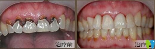 北京中諾口腔好不好？郭祖迎牙齒修復(fù)案例效果來(lái)驗(yàn)證