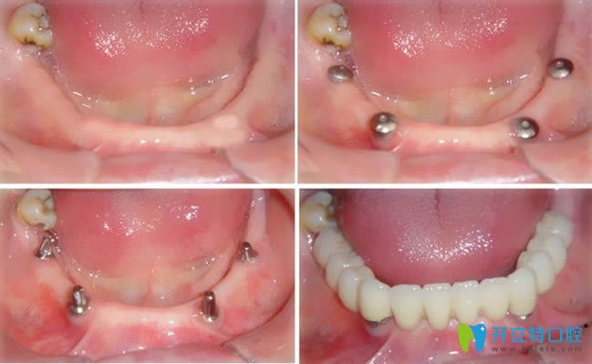即刻種植牙的真人案例效果圖