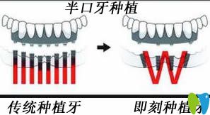即刻種植牙和普通種植牙的區(qū)別圖
