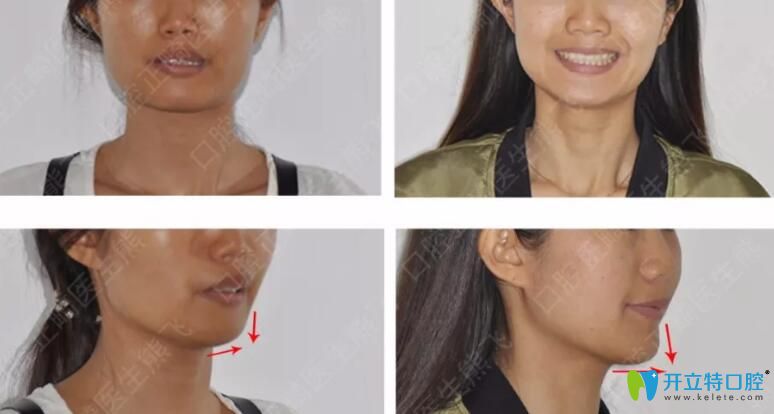 廣州圣貝口腔怎么樣？公布熊飛等醫(yī)生牙齒矯正案例