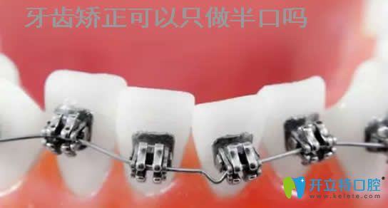 牙齒可以只矯正半口嗎？為什么醫(yī)生不建議只做半口矯正？