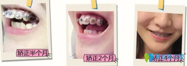 廣州圣貝口腔蔡菁菁牙齒矯正案例