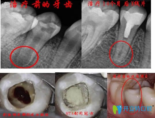 年輕恒牙牙髓再生術(shù)治療效果圖