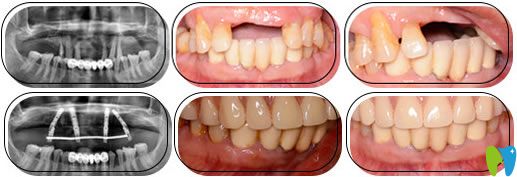 多顆牙缺失微創(chuàng)種植牙技術(shù)