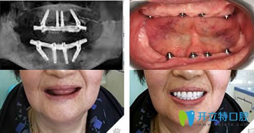 沈陽歡樂仁愛口腔全口牙種植對(duì)比圖