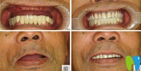 水激光種植牙技術(shù)前后對比圖