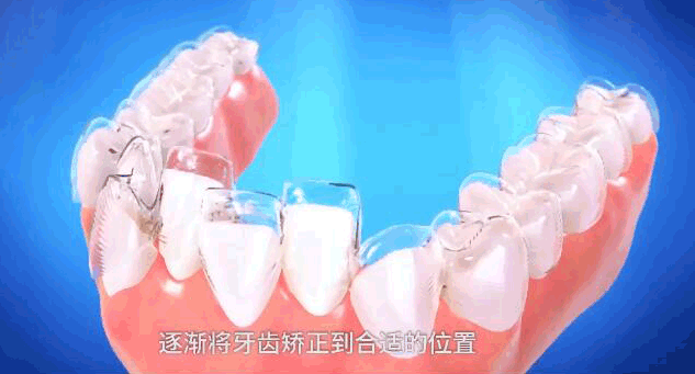 重慶成佳牙博士好不好呢，牙齒矯正效果來預見