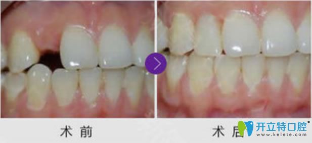 洛陽(yáng)拜博口腔單顆牙缺失種植牙前后對(duì)比效果