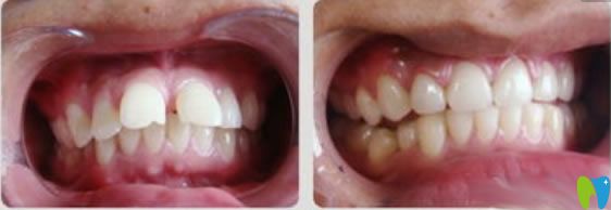 隱適美齙牙矯正前后對(duì)比圖